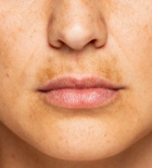 הידרוקינון - תמונת המחשה